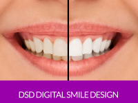 DSD- Digital Smile Design