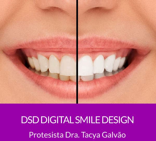 DSD- Digital Smile Design