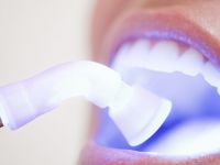 clareamento dental interno